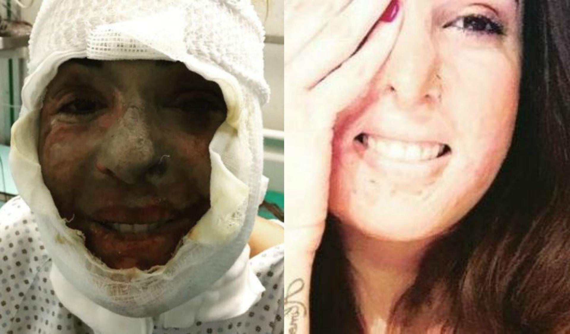 Gessica Notaro Posta La Foto Scattata Subito Dopo L Aggressione Con L Acido E Ringrazia Chi L Ha Aiutata Foto 1 Di 6 Radio 105