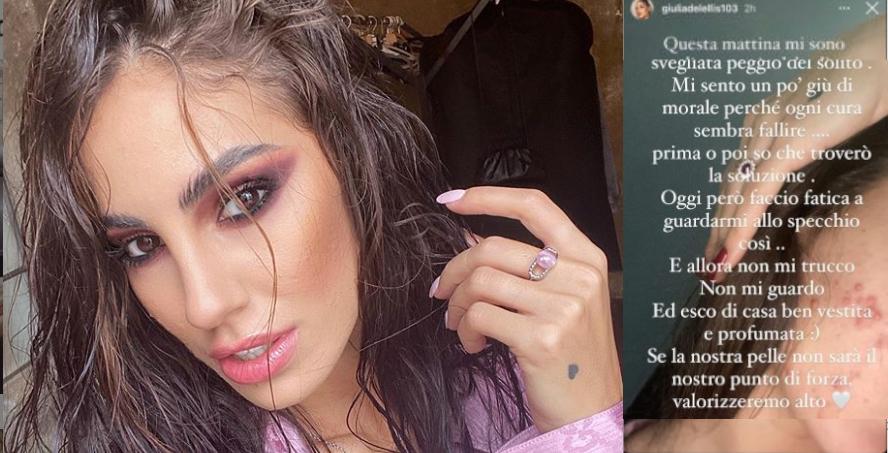 Giulia De Lellis Stanca Dei Problemi Con L Acne Ogni Cura Sembra Fallire Radio 105