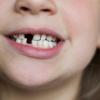 Denti che cadono