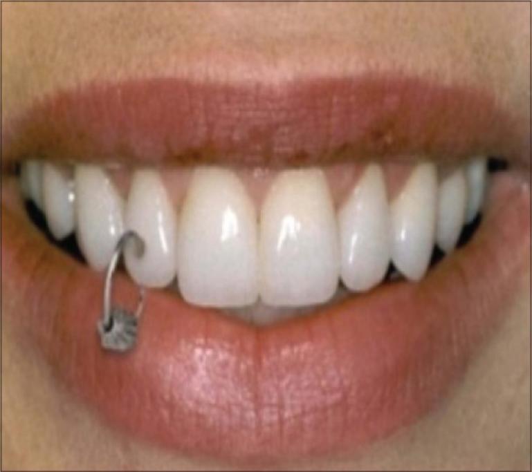 Sul dente