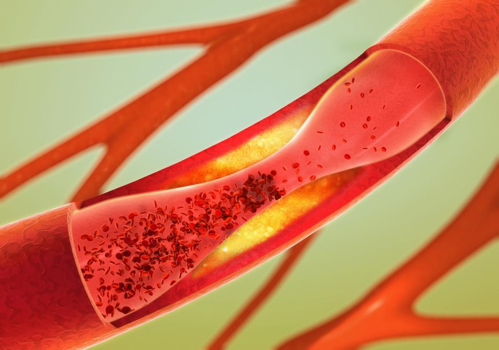 Malattie cardiovascolari