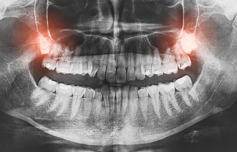 I denti del giudizio sono destinati a scomparire