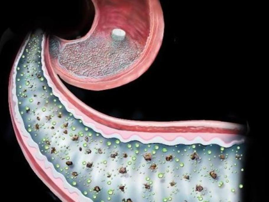 8 – La pillola chirurgica anti-diabete