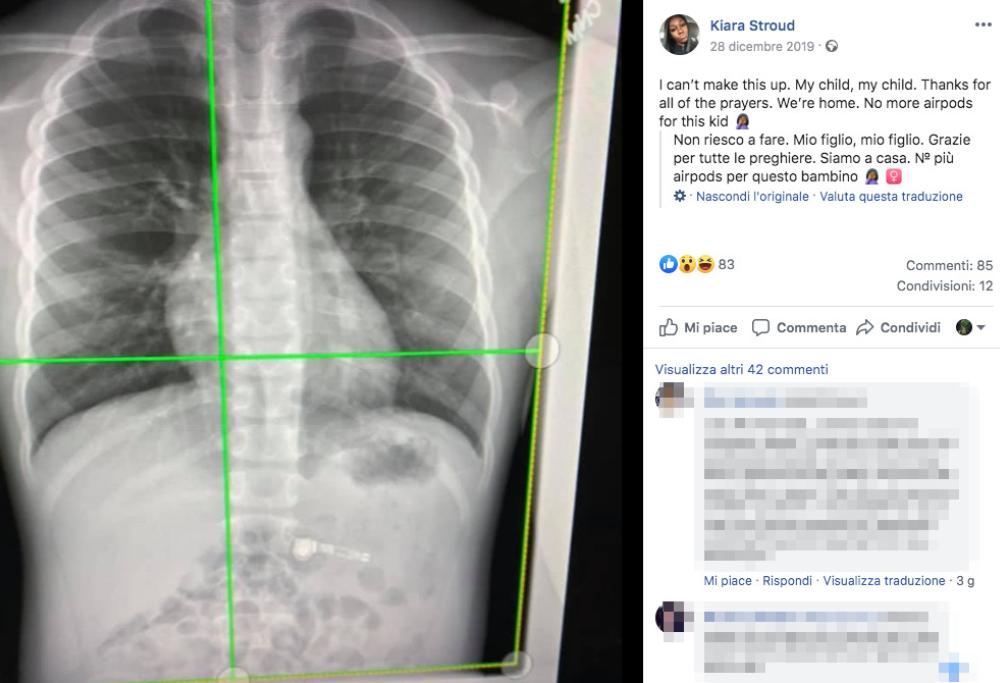 Bimbo ingoia un AirPod, la madre pubblica le lastra su Facebook