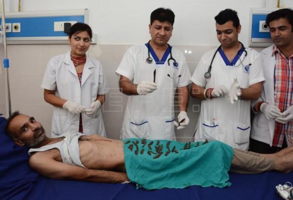 Operato per un tumore, gli vengono estratti 40 coltelli dallo stomaco
