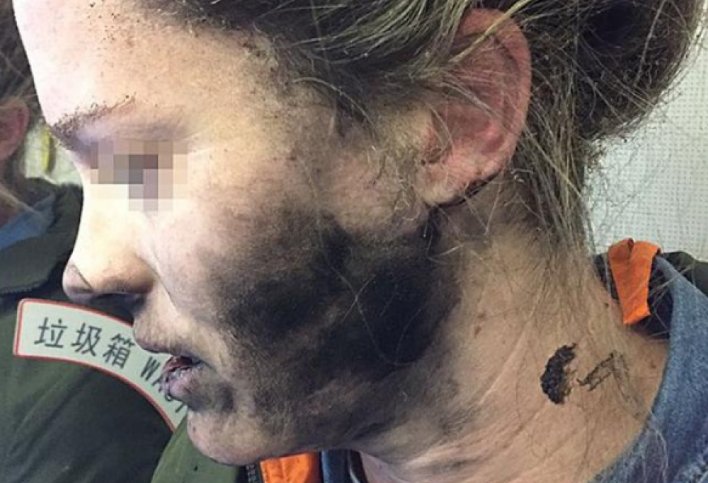 Esplodono le cuffie, donna ustionata al viso