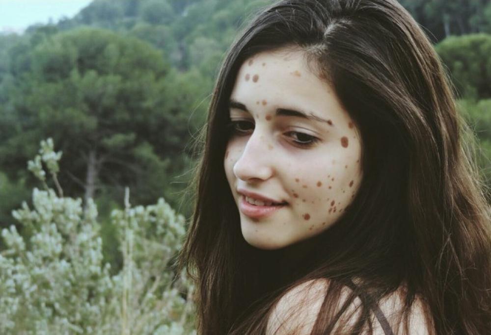 Il suo corpo è ricoperto di macchie, ora è una modella di successo