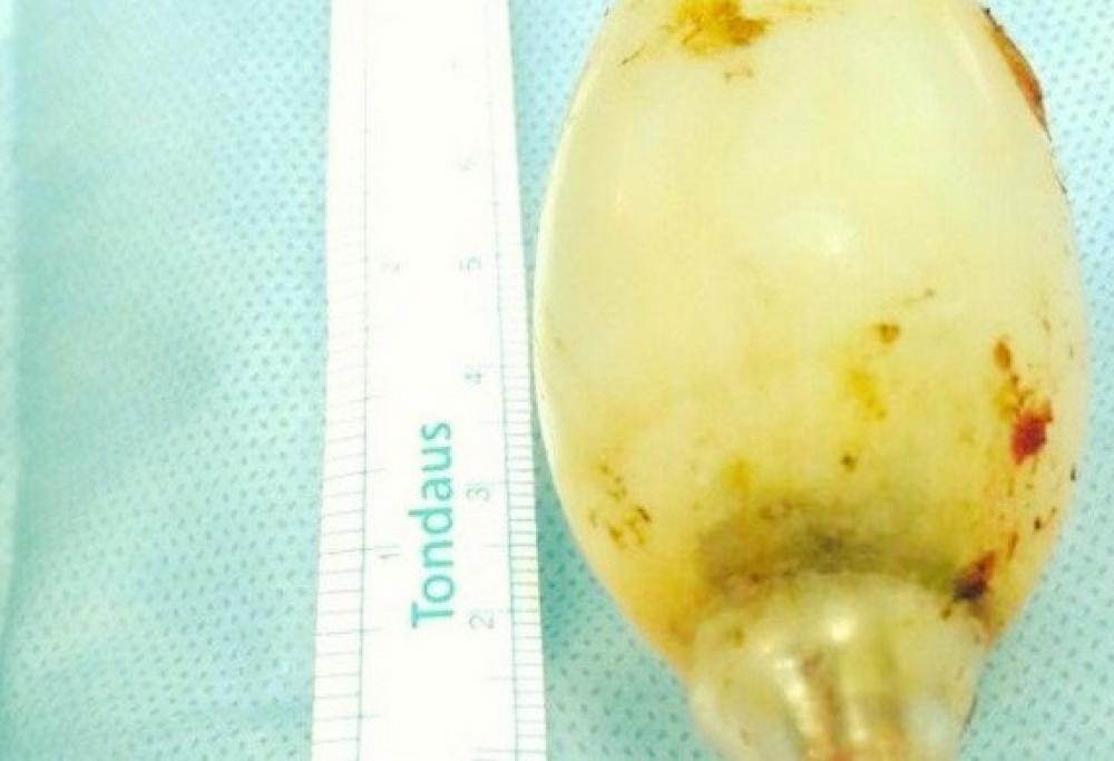 Ingoia una lampadina, viene operato 11 anni dopo