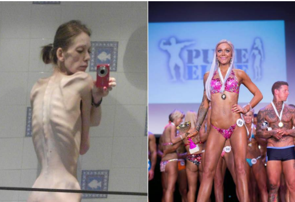 Dall’anoressia al body building: la vittoria di una ragazza britannica