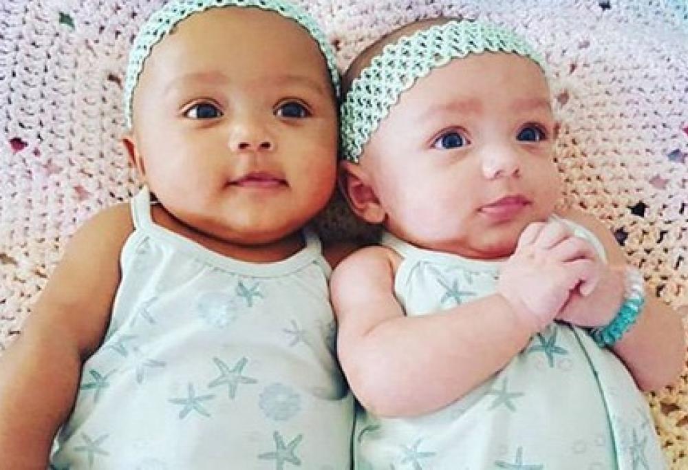 Gemelline: una ha la pelle bianca e l'altra di colore