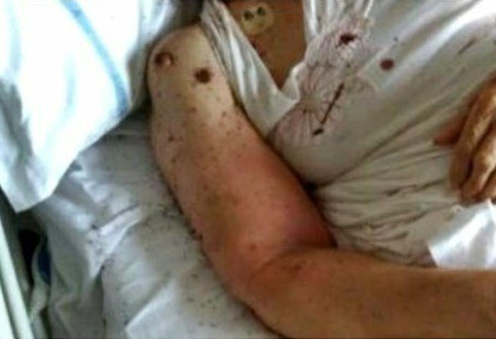 Napoli: formiche sul letto d'ospedale di una paziente, "è disumano"