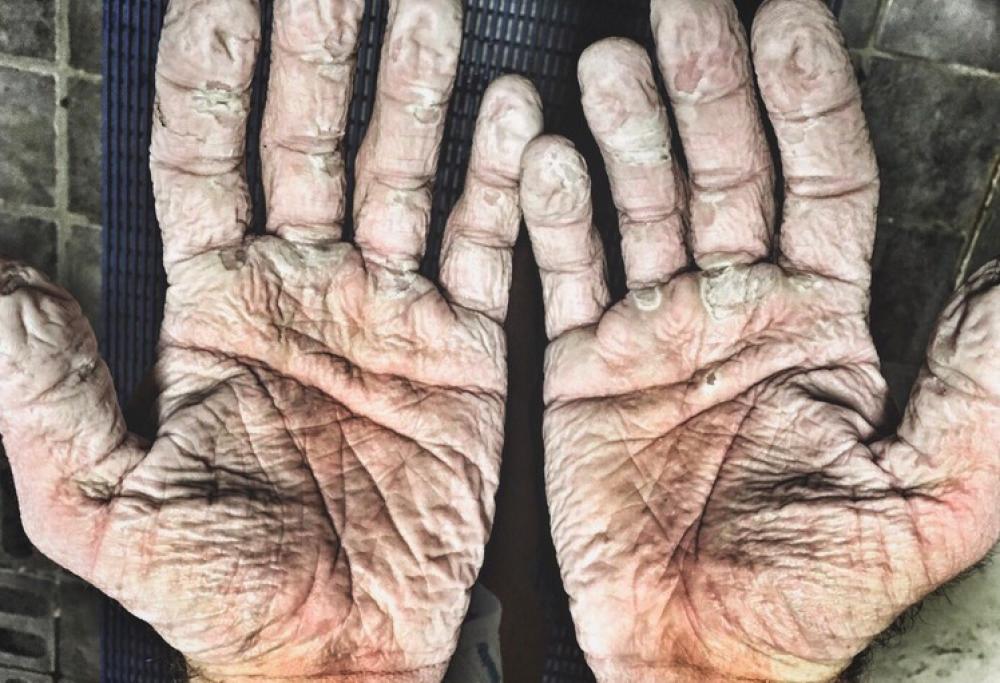 Mani provate da gelo e fatica: ecco la foto dell’olimpionico Alex Gregory
