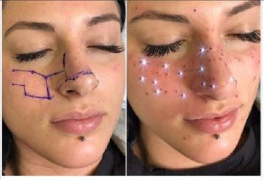 Nuova tendenza: tatuarsi il segno zodiacale con le lentiggini 
