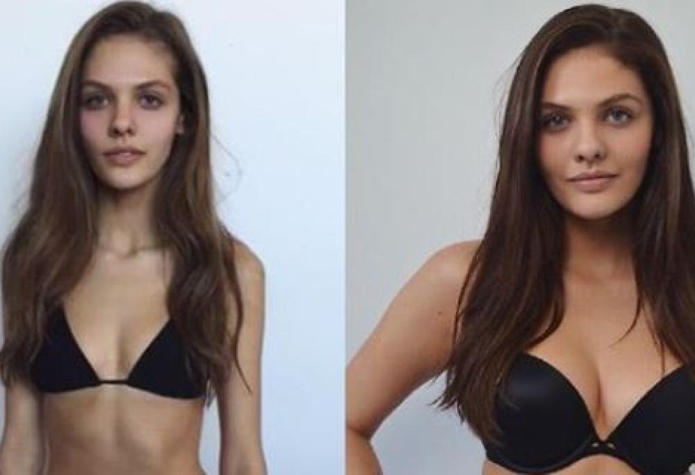 Modella troppo magra. L’agenzia di moda le propone un contratto a condizione che riprenda peso