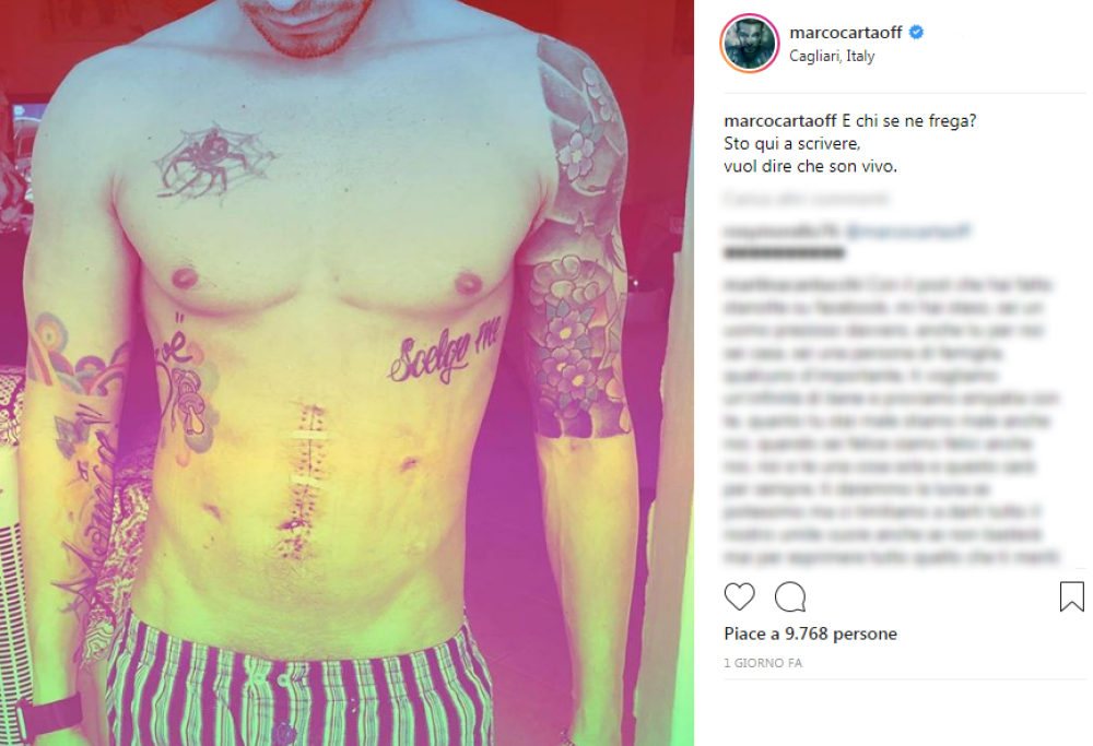 Marco Carta mostra la sua cicatrice su Instagram