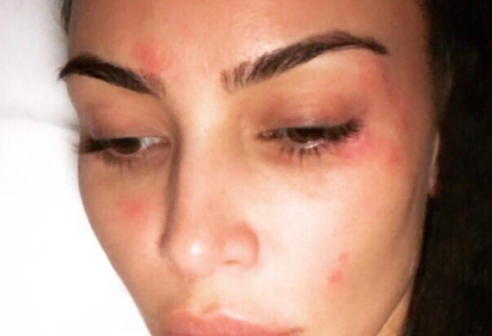 Kim Kardashian si mostra struccata e con i segni della psoriasi sul suo volto