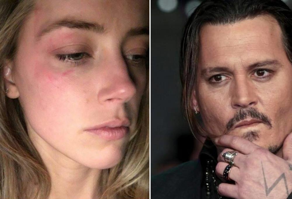 Johnny Depp accusa Amber Heard: "i lividi che ha mostrato sono finti!"