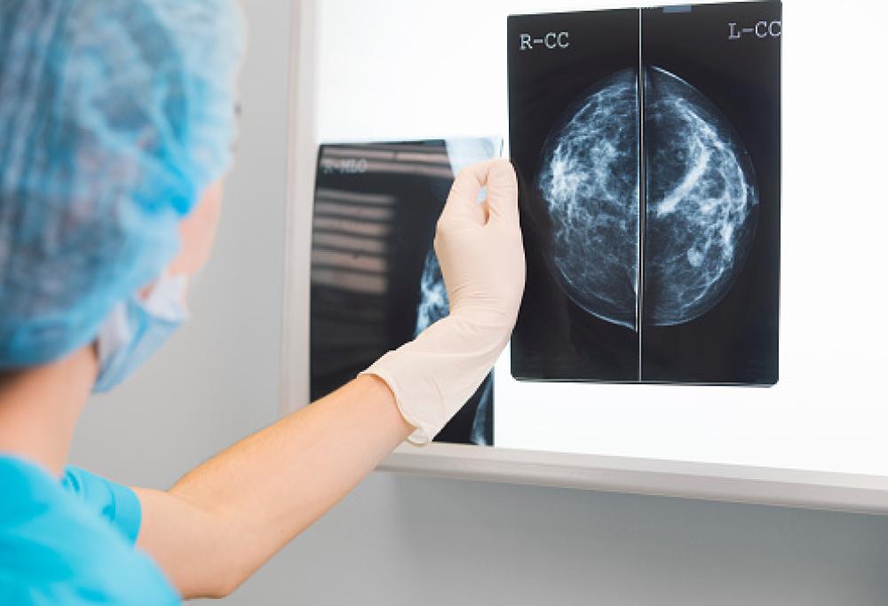 Una nuova terapia con cellule immunitarie ha sconfitto il cancro al seno
