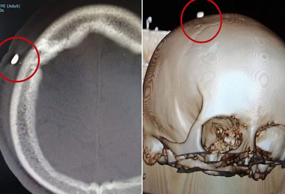 14enne morso alla testa durante una partita a calcio: un dente gli si conficca nel cranio