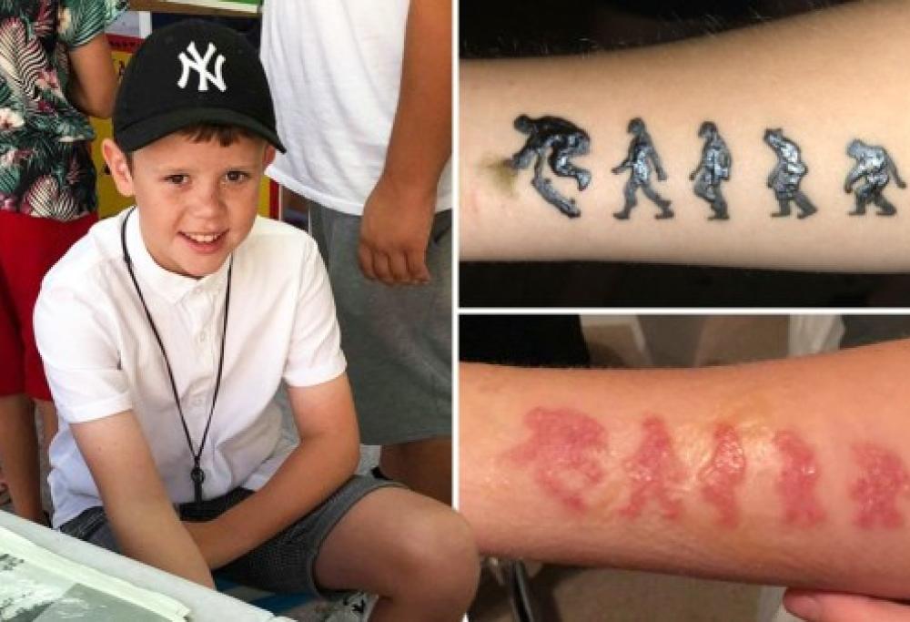 Bimbo ustionato da un tatoo all’henné: aveva assillato la madre per averlo