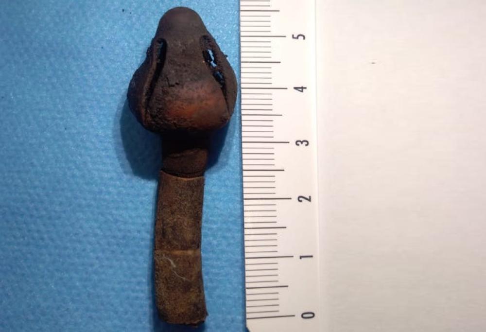 Medici estraggono un tubo dallo stomaco di una donna: era lì da 20 anni