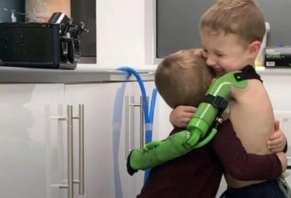 Bimbo nato senza un arto può finalmente abbracciare il fratello con un braccio bionico