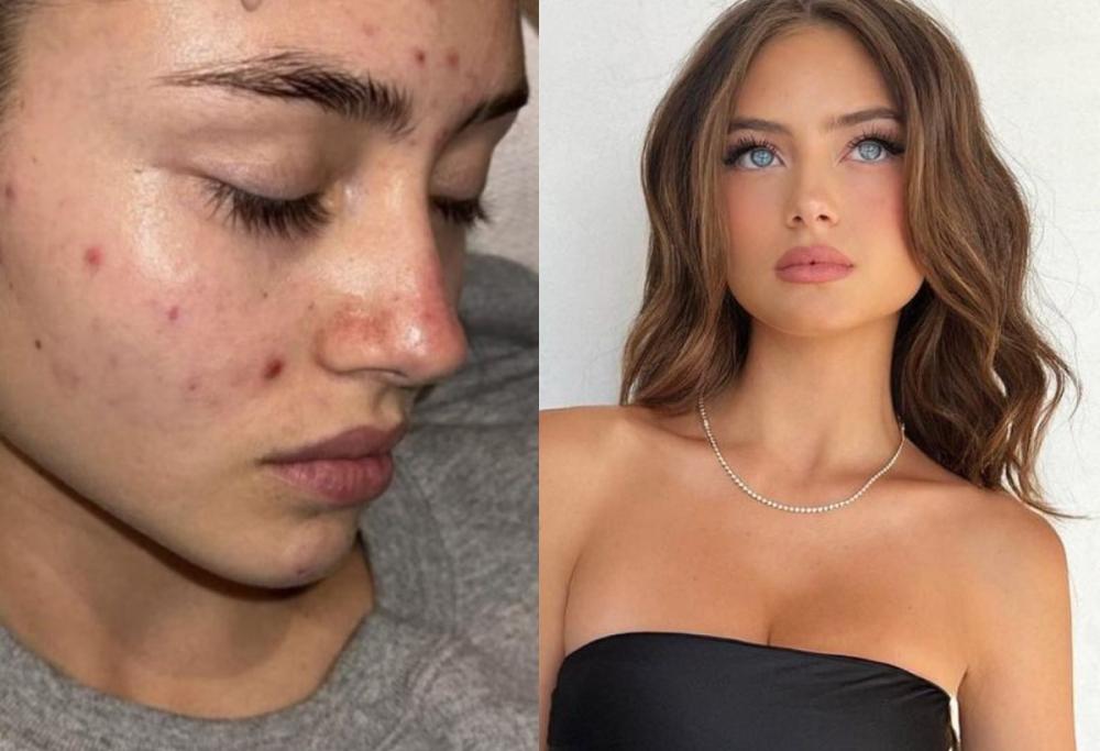 Leni Klum mostra la sua lotta contro l’acne: il selfie senza filtri 