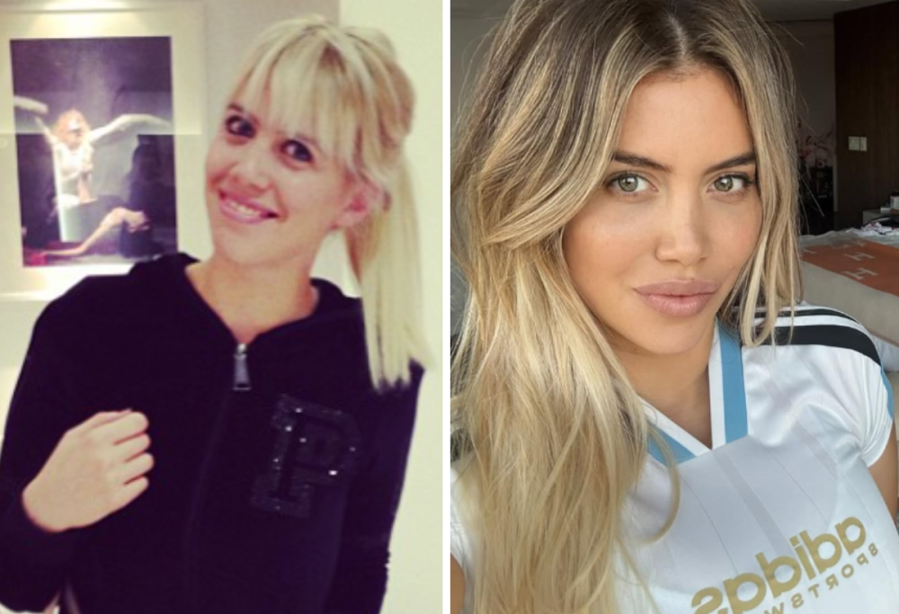 Wanda Nara prima e dopo: i ritocchi estetici a cui si è sottoposta