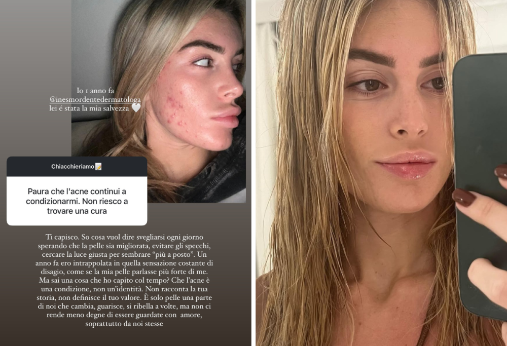 Sophie Codegoni racconta la battaglia contro l’acne: le sue parole