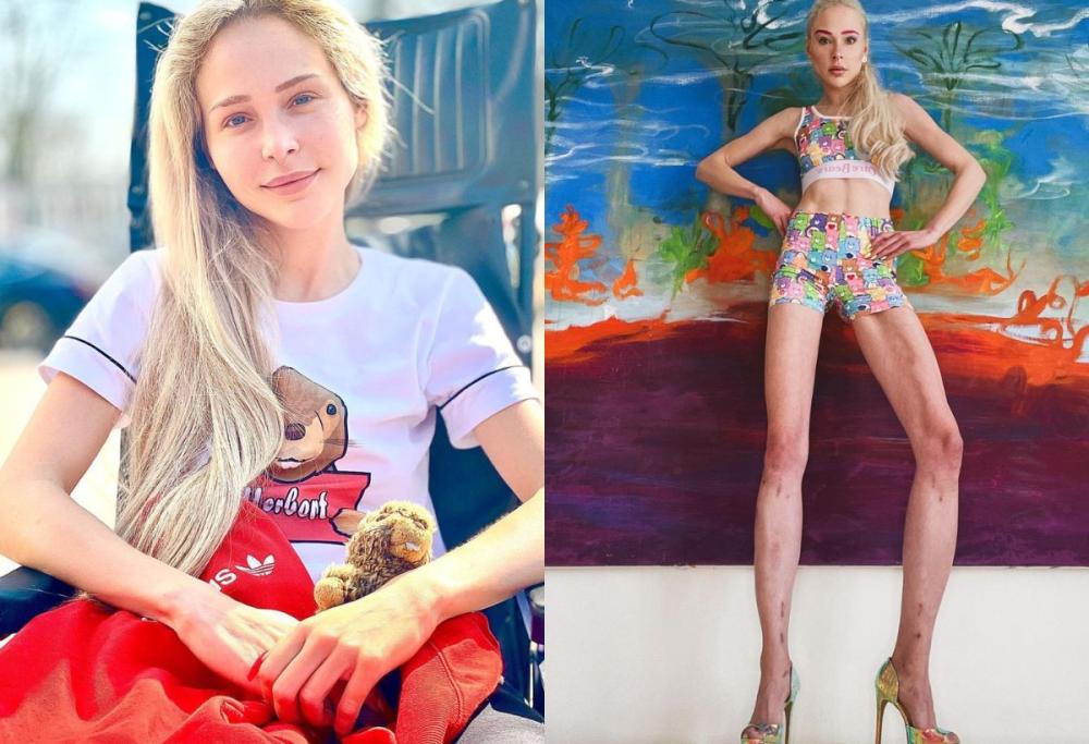 Spende 150mila per farsi allungare le gambe: l’incredibile storia