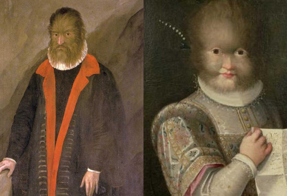 La Bella e la Bestia è la storia vera di un uomo con una rara malattia