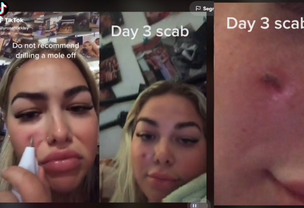 Cerca di rimuovere un neo trapanandolo e mette il video su TikTok