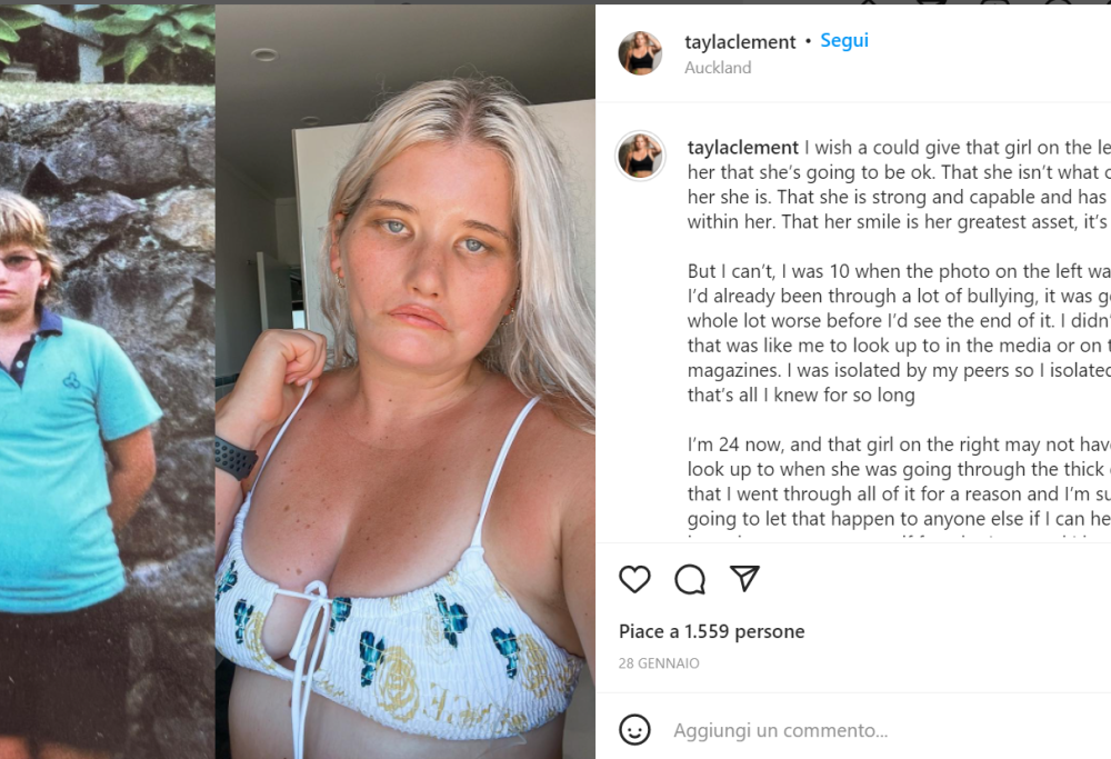 “La ragazza che non può sorridere” oggi è una modella e influencer 