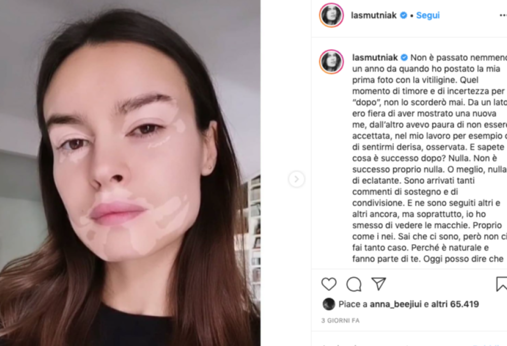 Kasia Smutniak crea Beautyligo, il filtro Instagram che riproduce la vitiligine