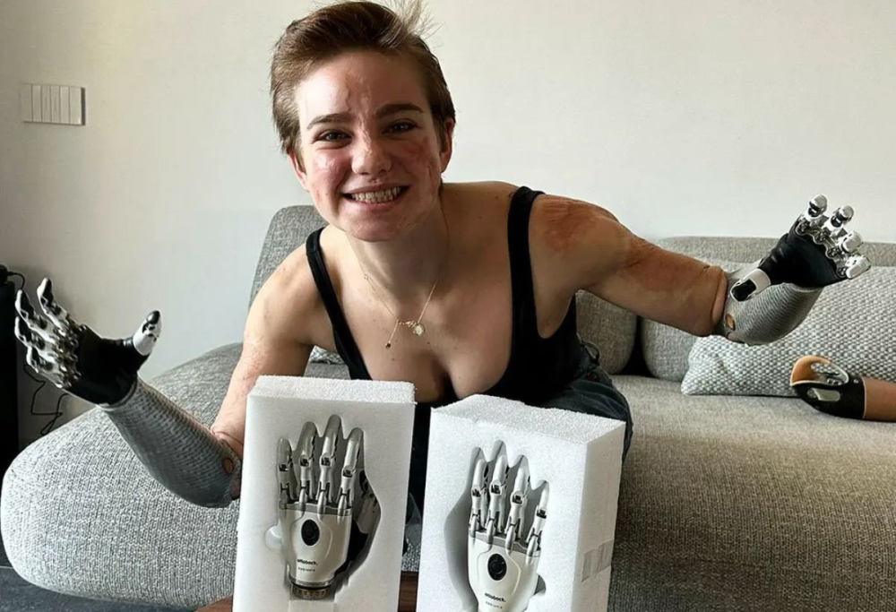 Bebe Vio e le sue “nuove mani bioniche”
