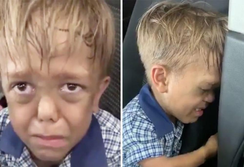 "Voglio morire”: madre mostra gli effetti del bullismo sul figlio affetto da nanismo
