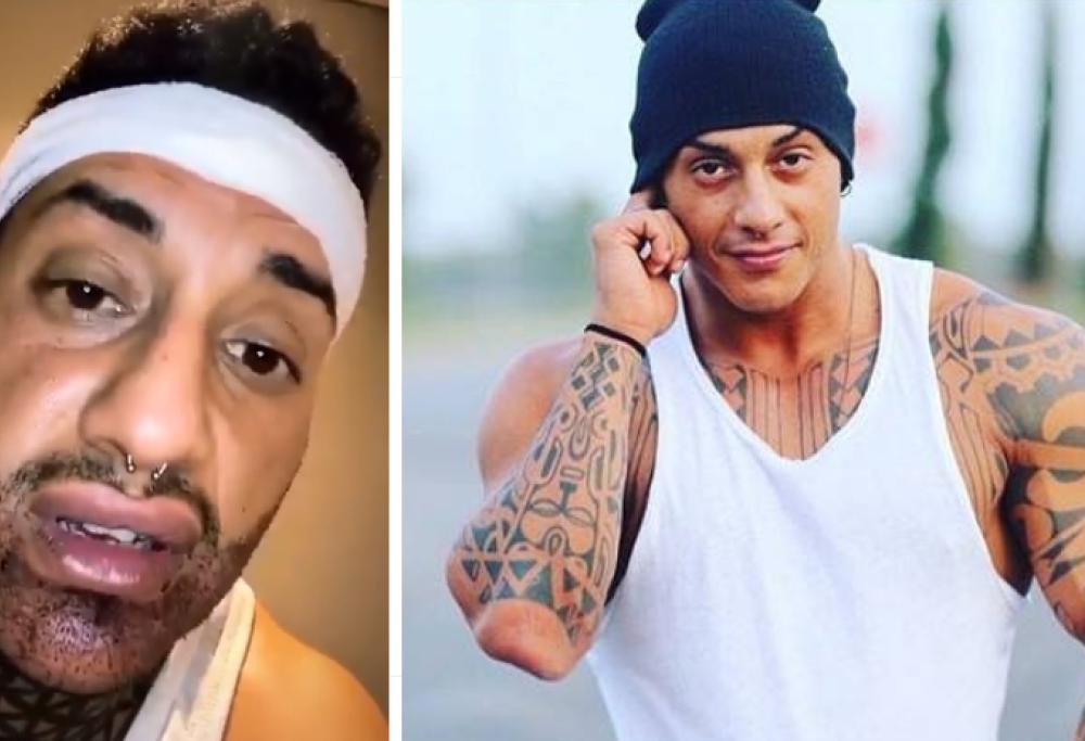 Francesco Chiofalo mostra il volto tumefatto dopo un trapianto di barba