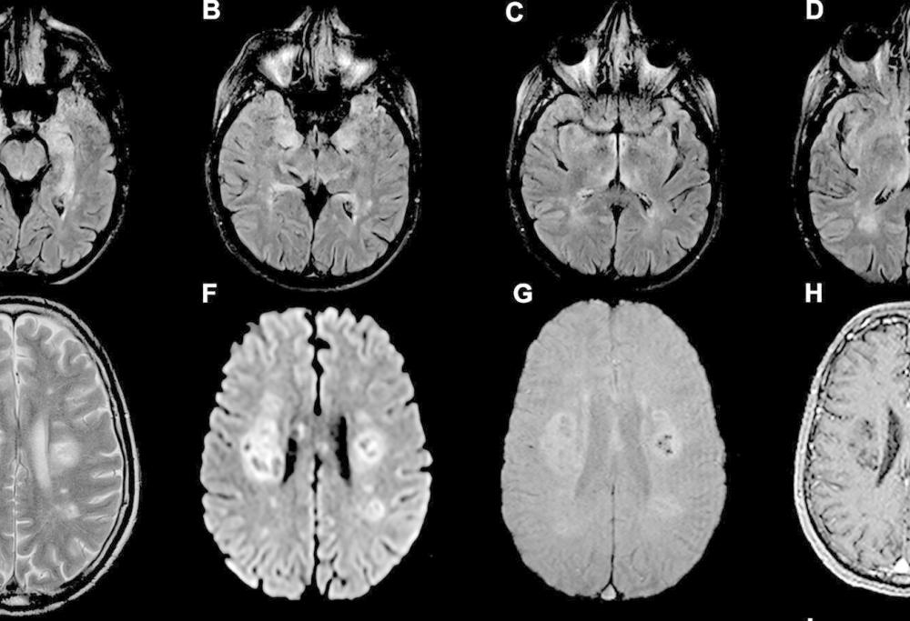 Il coronavirus attacca così il cervello: lo dice una ricerca (ma occorre approfondire)