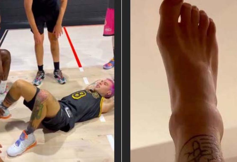 Fedez cade giocando a basket e si rompe i legamenti del piede