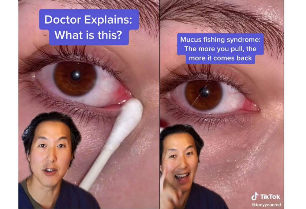 Cosa diavolo è la pericolosa moda TikTok chiamata “mucus fishing”?