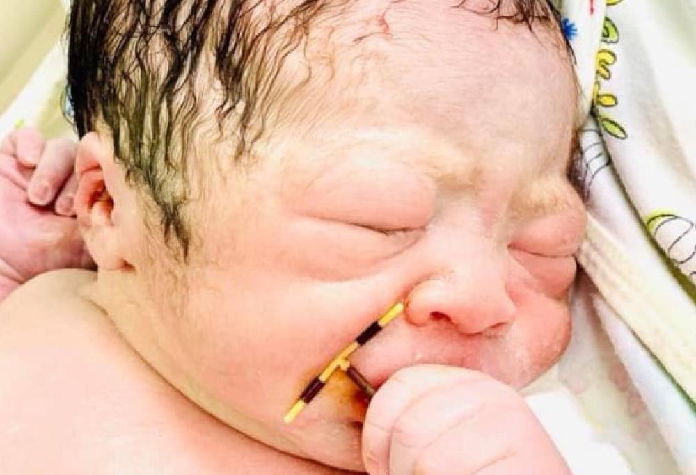 Il bimbo nato con la spirale in mano sta facendo il giro del mondo
