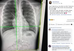 Bimbo ingoia un AirPod, la madre pubblica la lastra su Facebook
