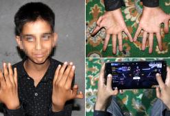 Ragazzo nato con due pollici in più: "Gioco meglio ai videogiochi"