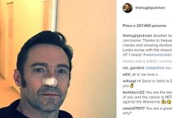 Hugh Jackman, altra vittoria contro il cancro alla pelle