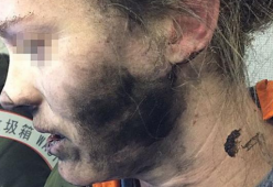 Esplodono le cuffie, donna ustionata al viso