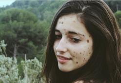 Il suo corpo è ricoperto di macchie, ora è una modella di successo