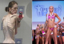 Dall’anoressia al body building: la vittoria di una ragazza britannica