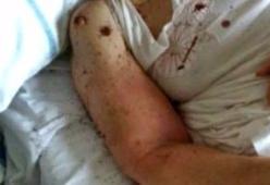 Napoli: formiche sul letto d'ospedale di una paziente, "è disumano"