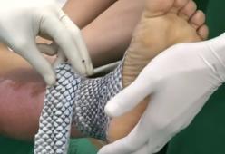 In Brasile usano la pelle di pesce per curare le ustioni