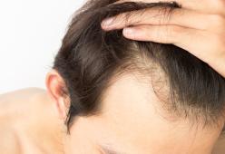 Autunno, capelli a rischio caduta: ecco come rimediare 